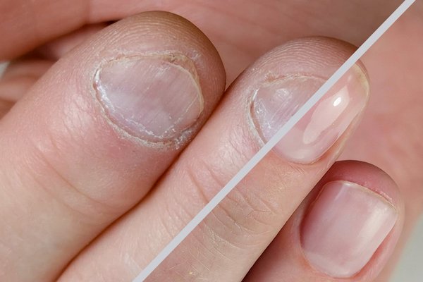 Nagelbijters – De specialisatie voor de salon